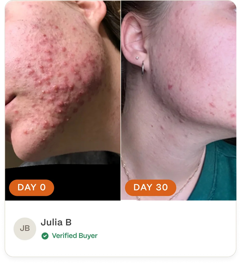 Complete Acne Skin System — Calm Breakouts, Support Your Skin Barrier & Hydrate