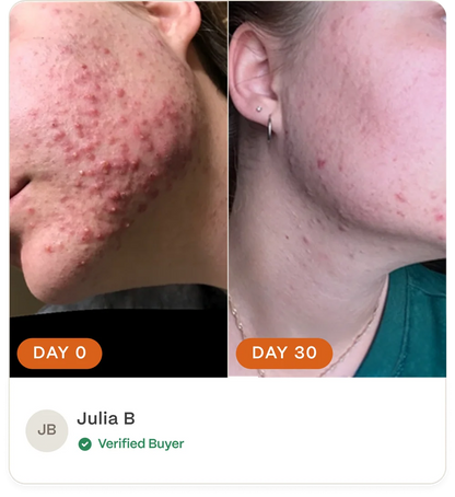 Complete Acne Skin System — Calm Breakouts, Support Your Skin Barrier & Hydrate