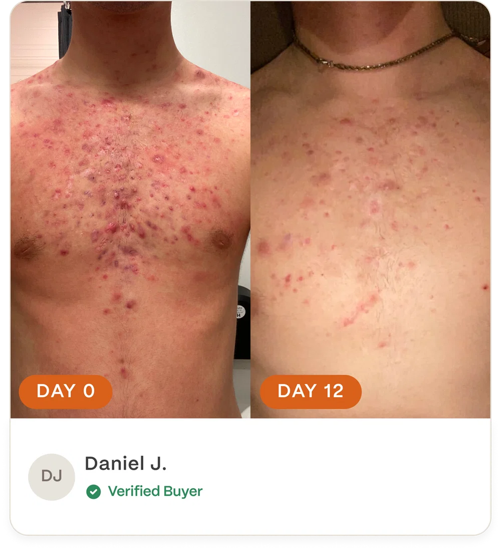 Complete Acne Skin System — Calm Breakouts, Support Your Skin Barrier & Hydrate