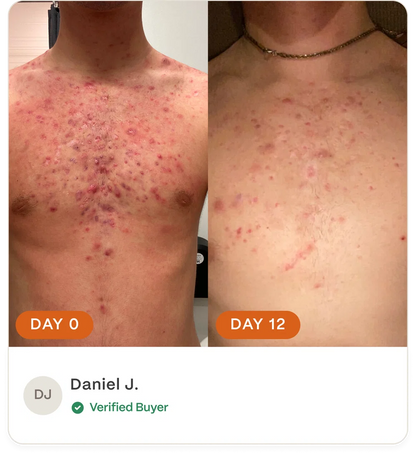 Complete Acne Skin System — Calm Breakouts, Support Your Skin Barrier & Hydrate