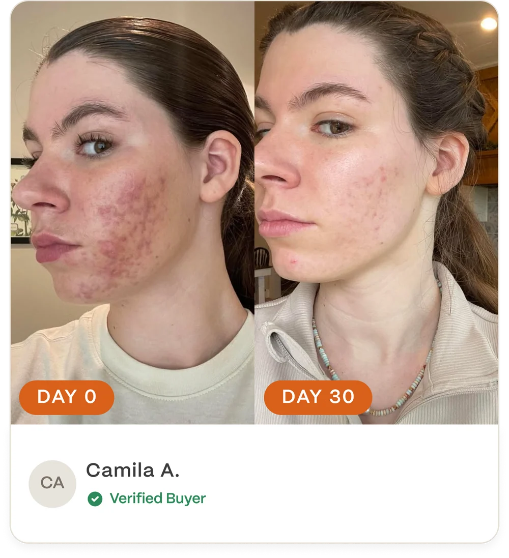 Complete Acne Skin System — Calm Breakouts, Support Your Skin Barrier & Hydrate