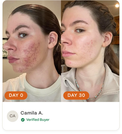 Complete Acne Skin System — Calm Breakouts, Support Your Skin Barrier & Hydrate