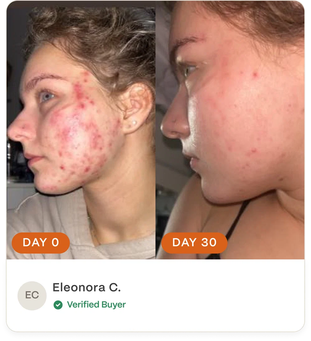 Complete Acne Skin System — Calm Breakouts, Support Your Skin Barrier & Hydrate