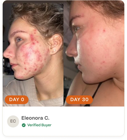 Complete Acne Skin System — Calm Breakouts, Support Your Skin Barrier & Hydrate