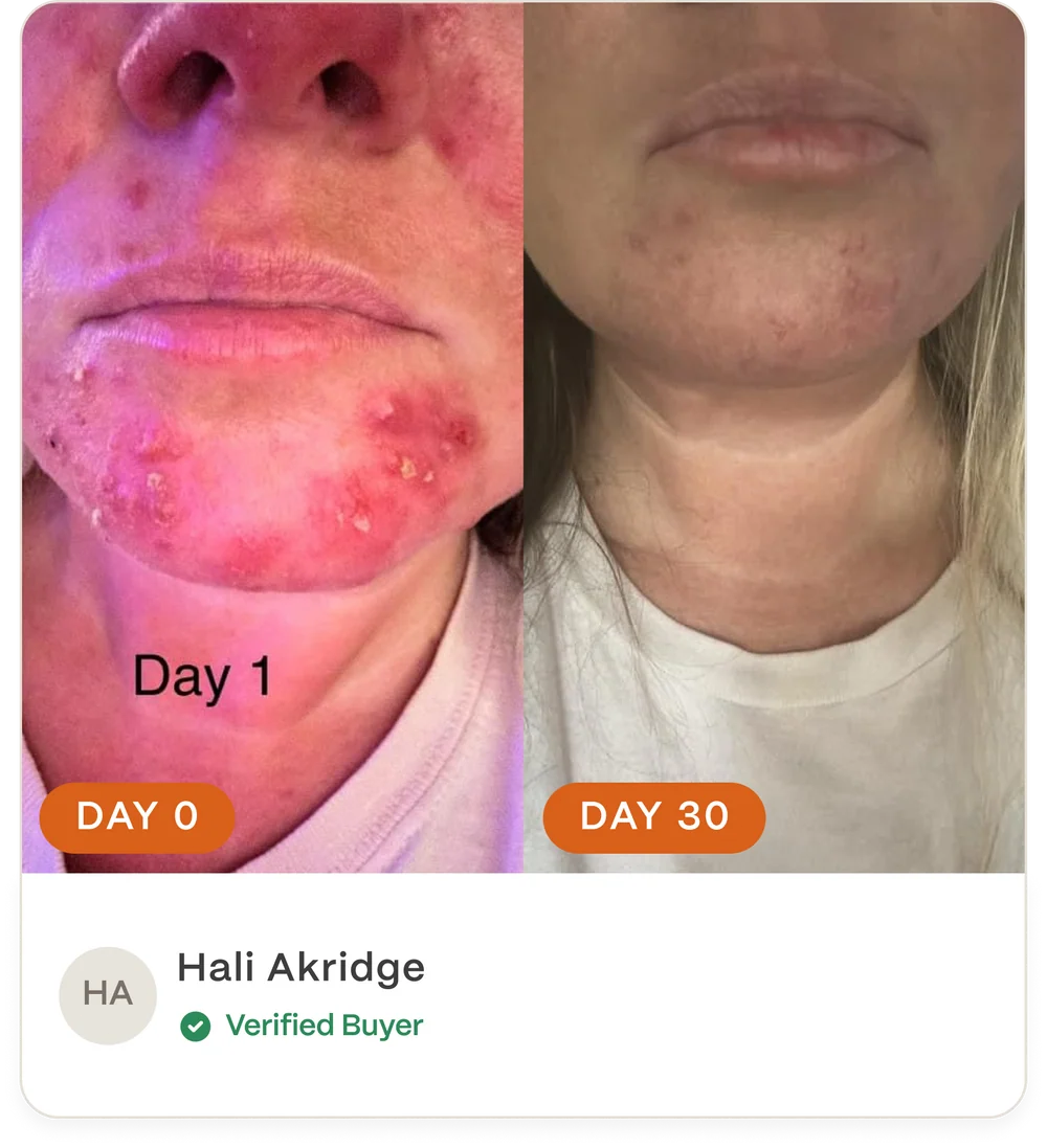 Complete Acne Skin System — Calm Breakouts, Support Your Skin Barrier & Hydrate
