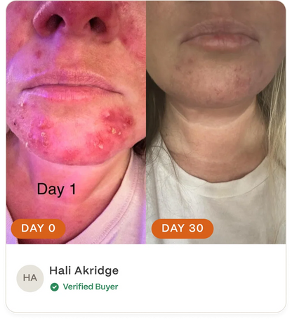 Complete Acne Skin System — Calm Breakouts, Support Your Skin Barrier & Hydrate