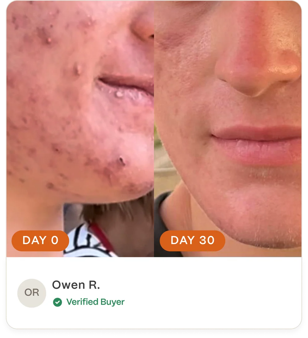 Complete Acne Skin System — Calm Breakouts, Support Your Skin Barrier & Hydrate