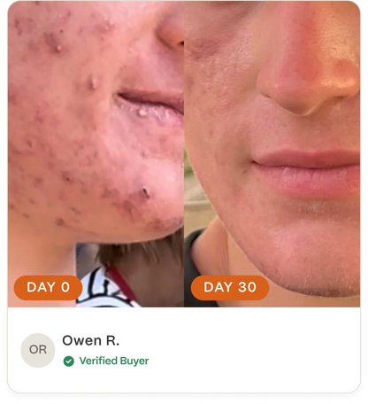 Complete Acne Skin System — Calm Breakouts, Support Your Skin Barrier & Hydrate