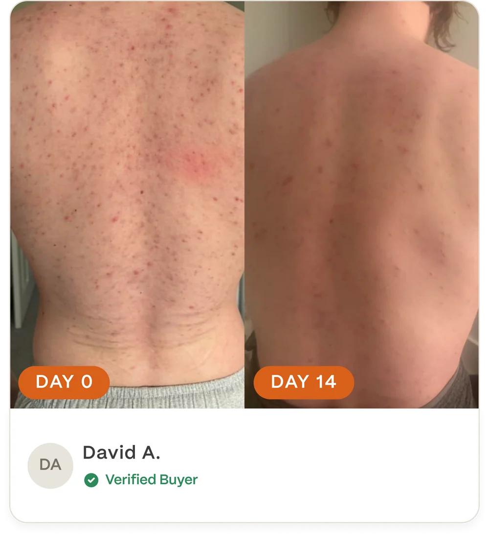 Complete Acne Skin System — Calm Breakouts, Support Your Skin Barrier & Hydrate