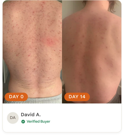 Complete Acne Skin System — Calm Breakouts, Support Your Skin Barrier & Hydrate